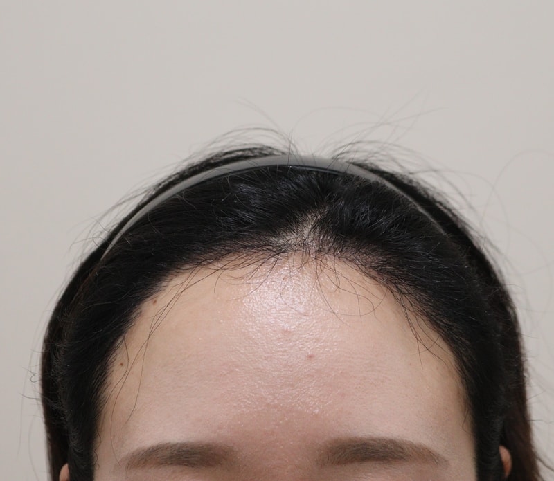 3. 수술후_6개월_1.JPG