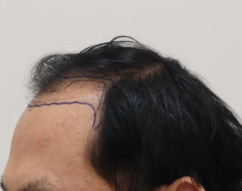 1. 수술전_2.JPG