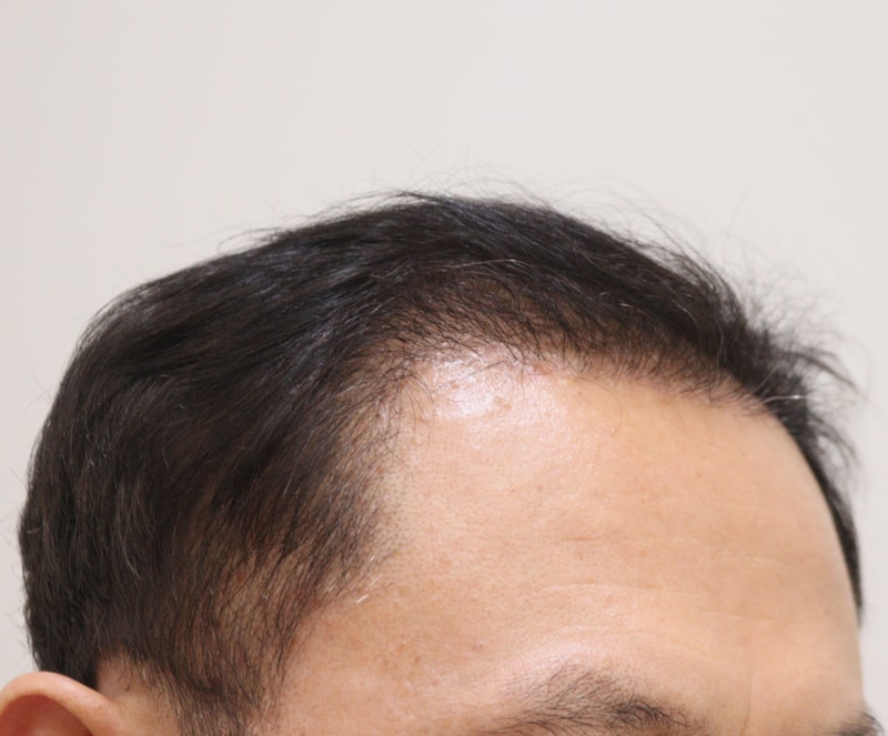 3. 수술후_6개월_3.JPG