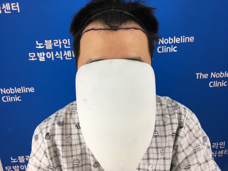찐 실력자 노블라인 백현욱 원장님 수술 209일째 입니다.