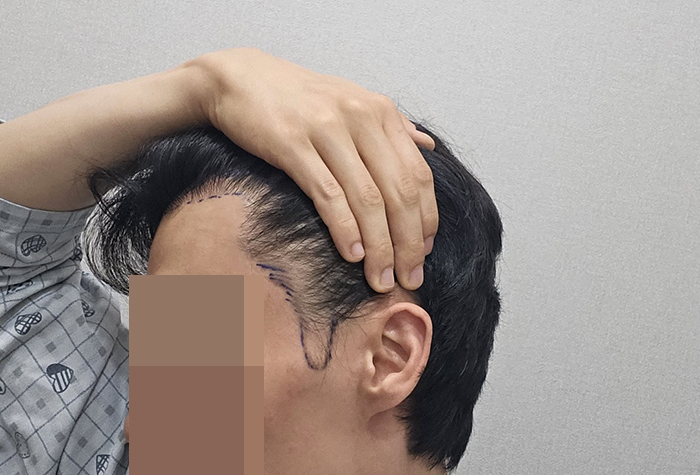 3.수술전 디자인 후.jpg