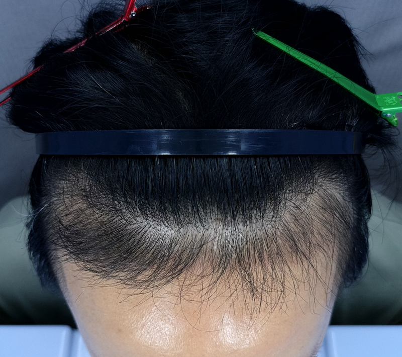 김영남81 이식3mo.png