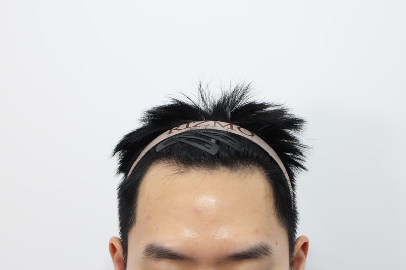 부산리즈모의원 모발이식 1년경과