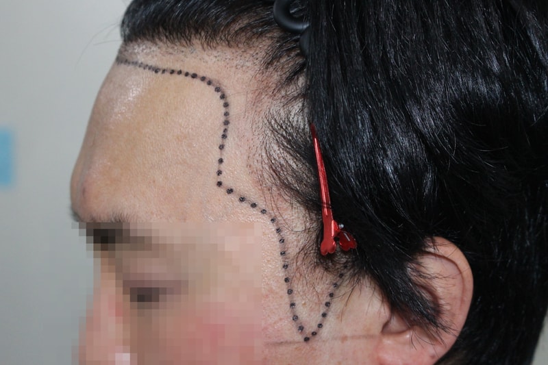 수술전 디자인(측면1).jpg