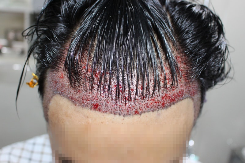 수술당일 디자인(정면2).jpg