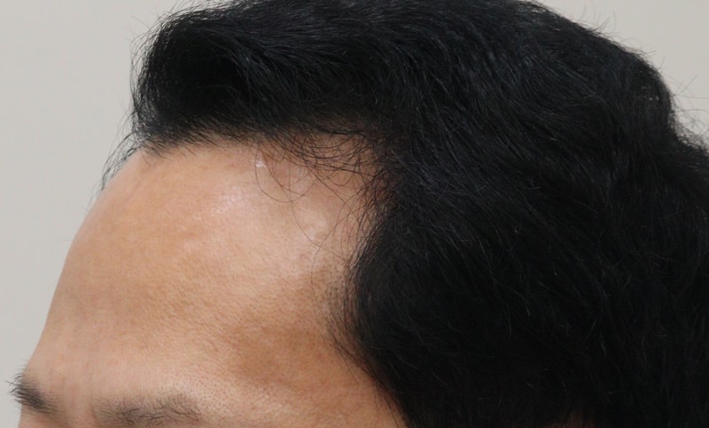 1. 수술전_2.JPG