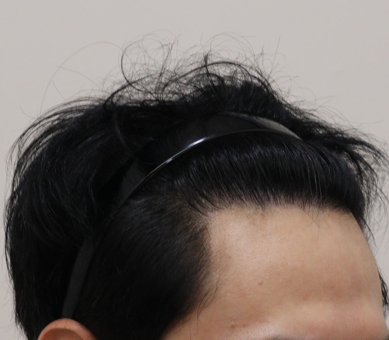 5. 수술후_1년_4.JPG