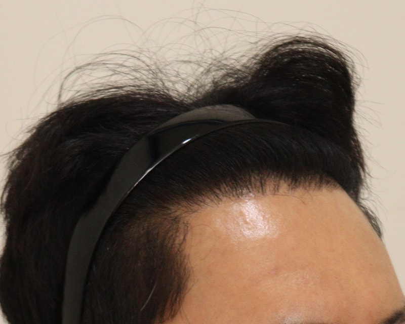 4. 수술후_1년_3.JPG