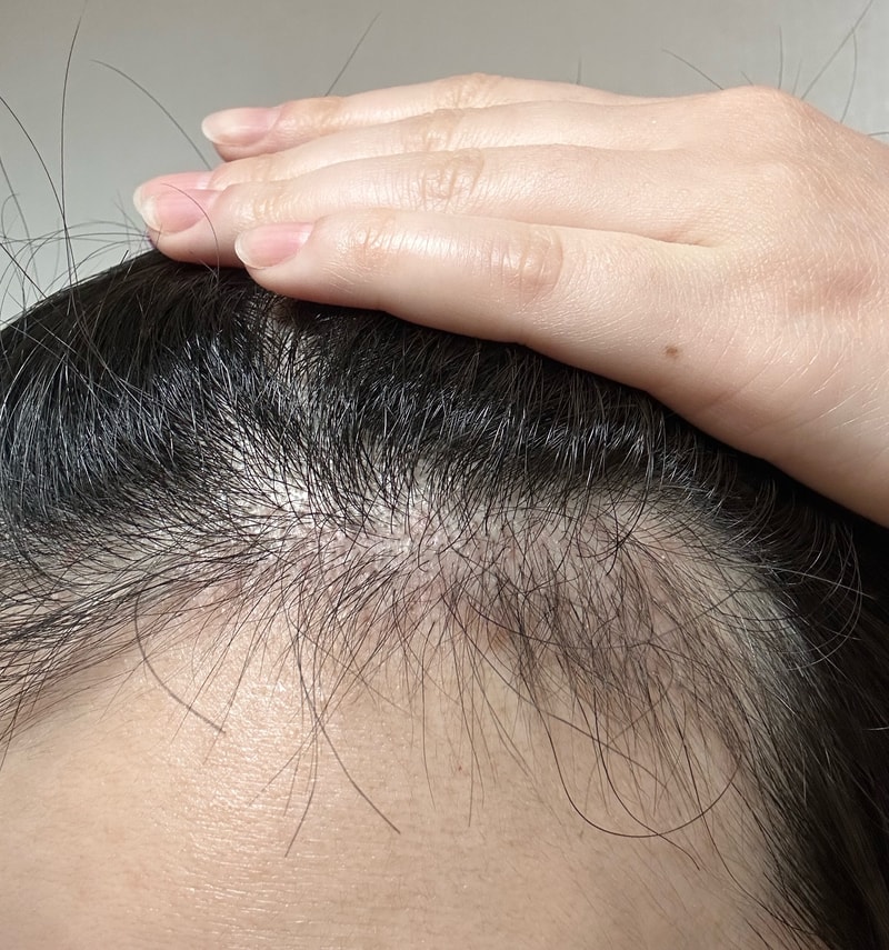 3. 수술후_3개월_셀카_3.jpg