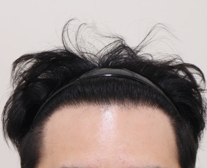4. 수술후_1년_1.JPG