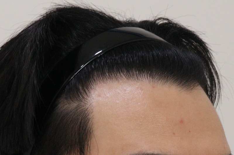 4. 수술후_1년_4.JPG