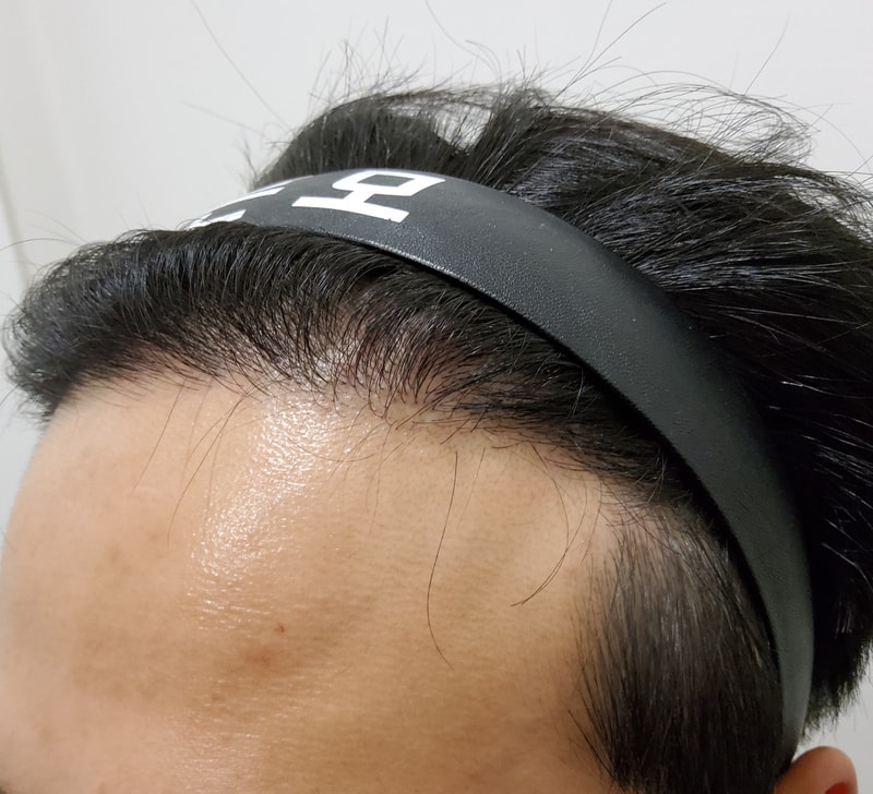 4. 수술후_1년_2.jpg
