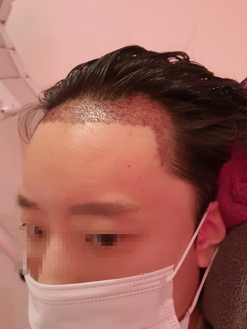 ニューヘア毛髪移植ヘアライン矯正1200毛包3日目の率直なレビューです。