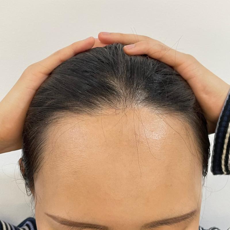 [DA] 整形外科女性发际线4500毛 (12个月)