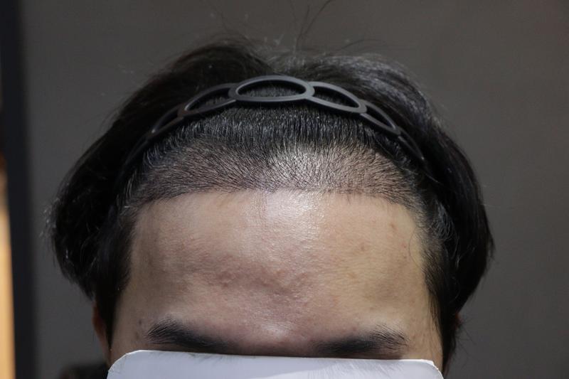 光州狎鸥亭摩比昂毛发移植两周后记
