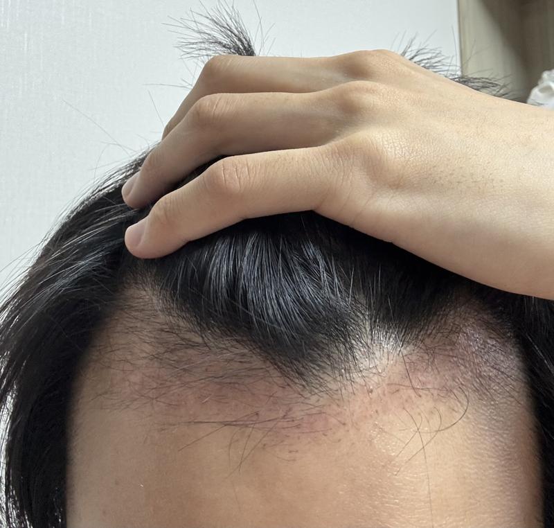 New Hair Seoul branch incision hair transplantation 1800 hair follicle surgery 3 months later.