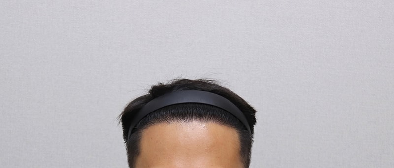 3. 1년 1개월 경과IMG_5227.JPG
