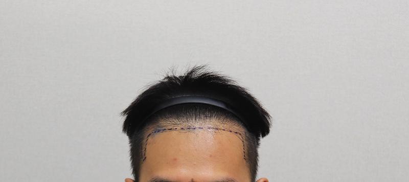 1.수술전 디자인 IMG_5182.JPG