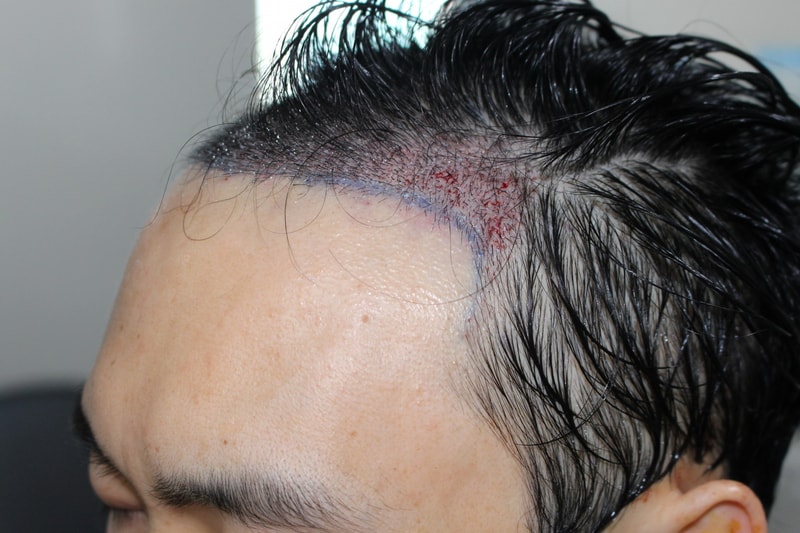 모발이식 고민끝에 모다올병원에 홍준현 원장님께 수술결정!