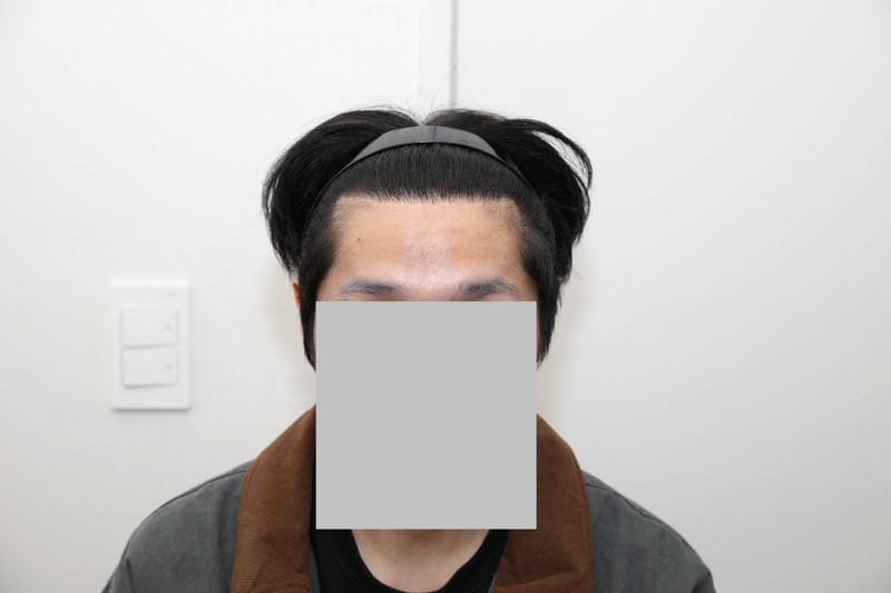 1300모낭 비절개 모발이식 226일차