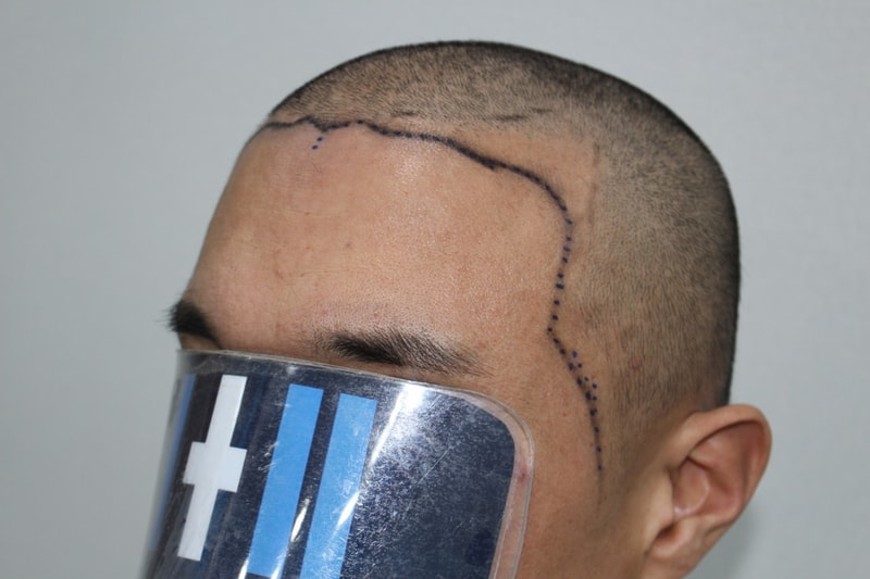 모더함의원 3200모 비절개 후기