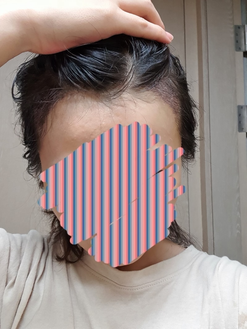 女士发际线