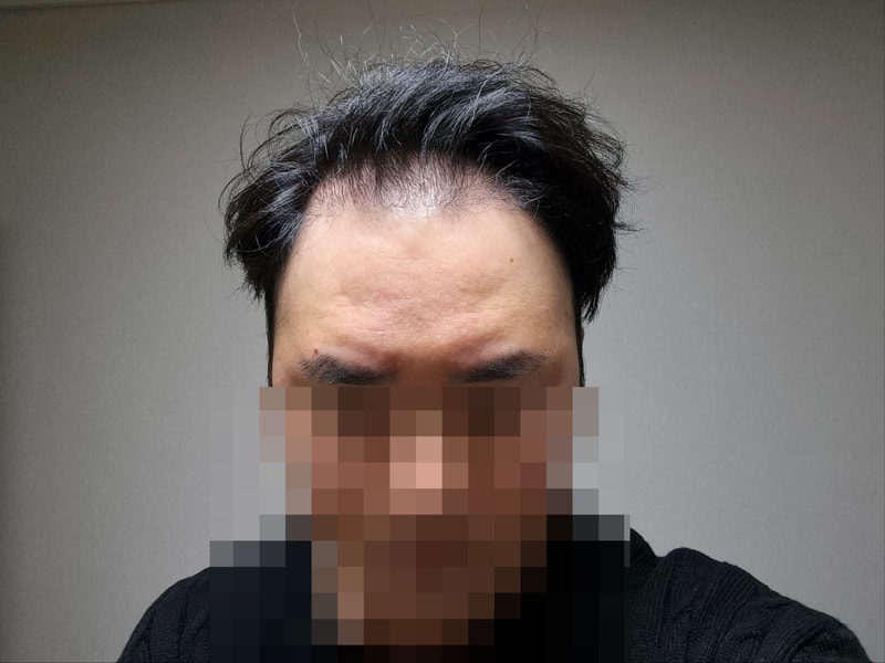 밴스모자이너 시술 찐후기(밀도보강, 라인결정)