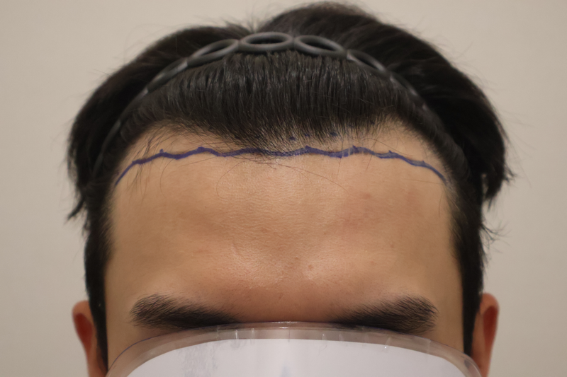 동탄 해어로의원 모발이식 후기
