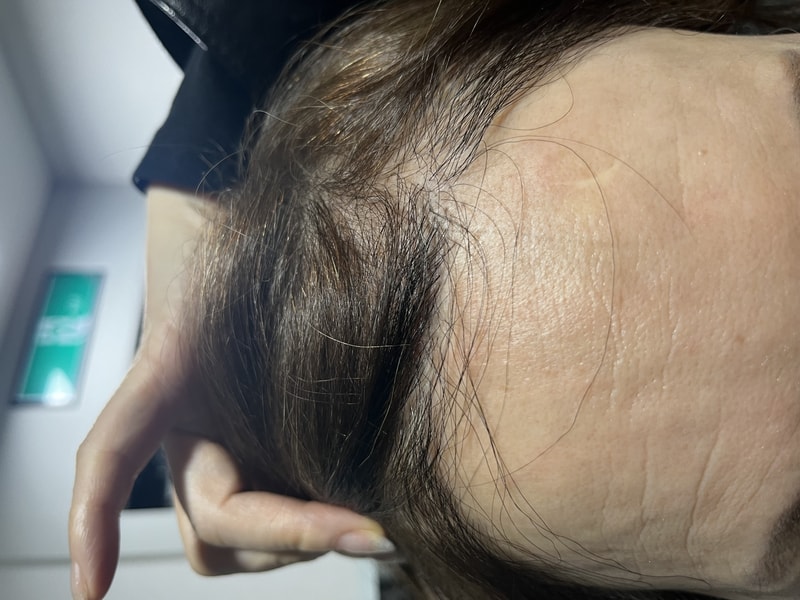 女性ヘアライン毛髪移植12ヶ月レビューです
