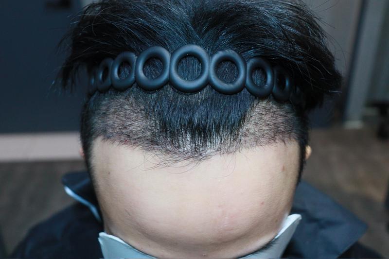 광주 압구정모비앙 모발이식수술 2주 경과 후기