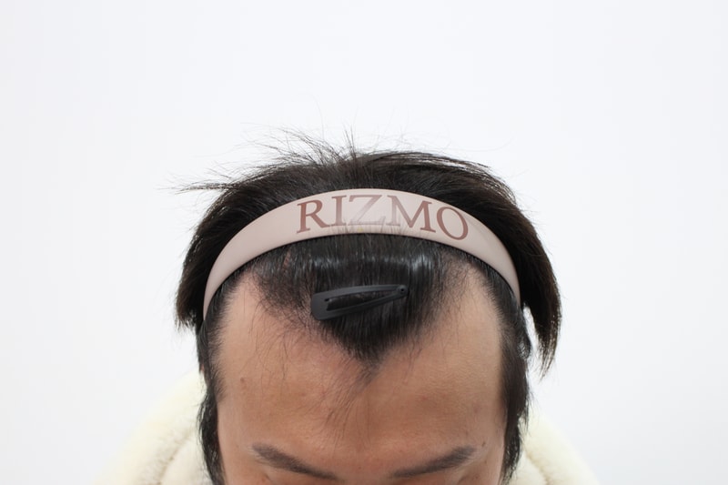 모발이식 3837모 8개월 경과