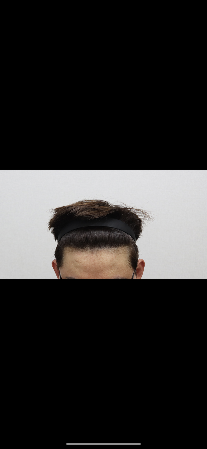 2次手術1年経過後のレビューです