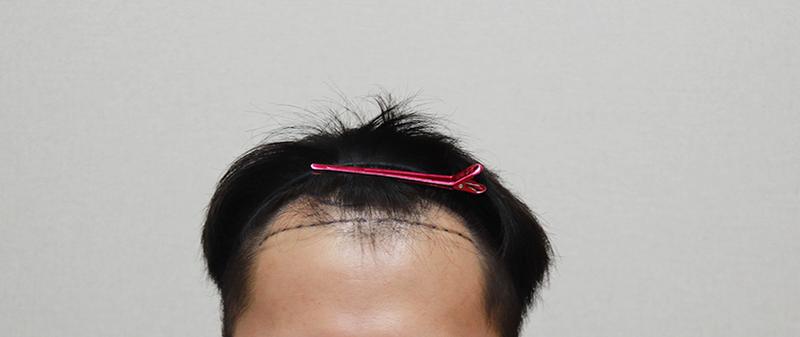 모플러스성형외과 M자 3000모 이식 후기