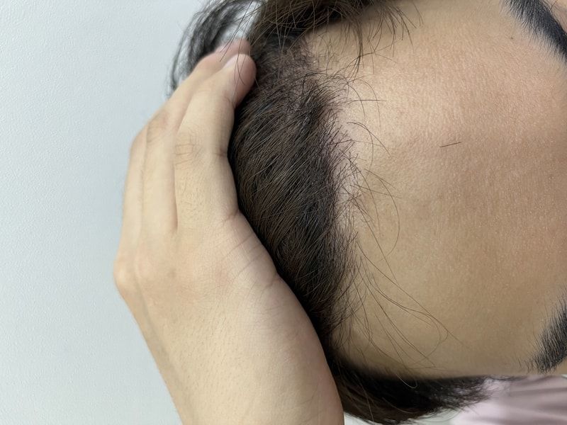 Gwangju Apgujeong Mobiang 2nd week hair transplant review!