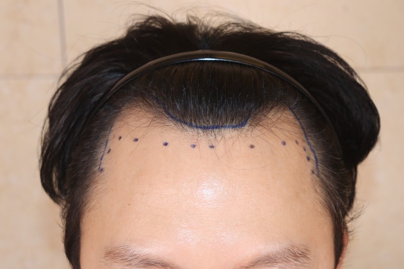 This is the 8th month review of the M-shape and Guretnaru Hair Transplant.