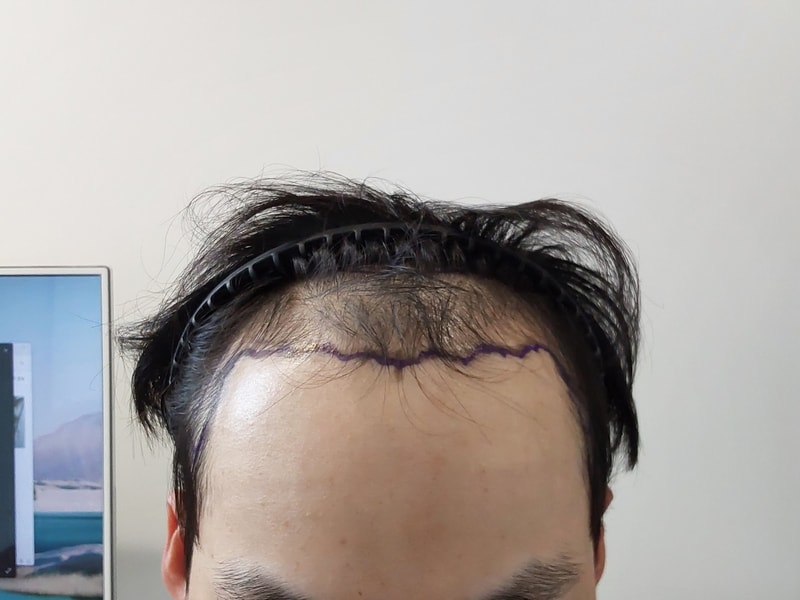 [자라다의원] 모발이식후기