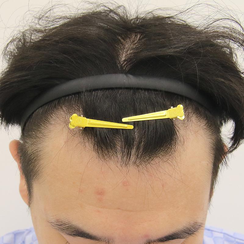 Busan Mammoth Hairline Hair Transplantation 2 Weeks Later