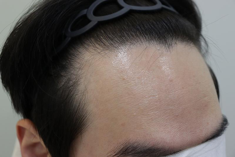 It is a review of hair transplantation after 10 months of Gwangju Apgujeong Mobiang Clinic.