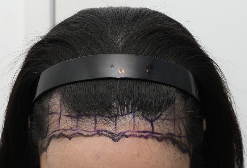 뉴헤어 헤어라인 비절개 1600모낭 2개월차