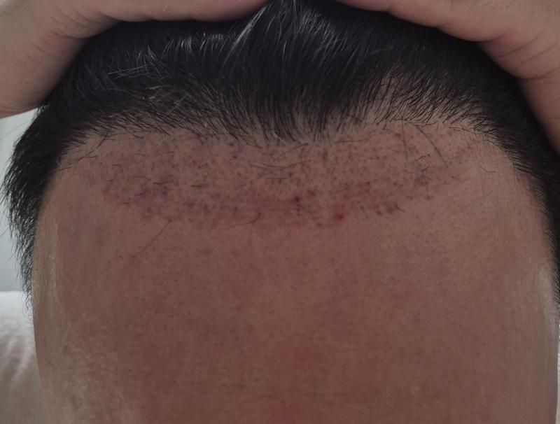 50 Days of Surgery Photo
