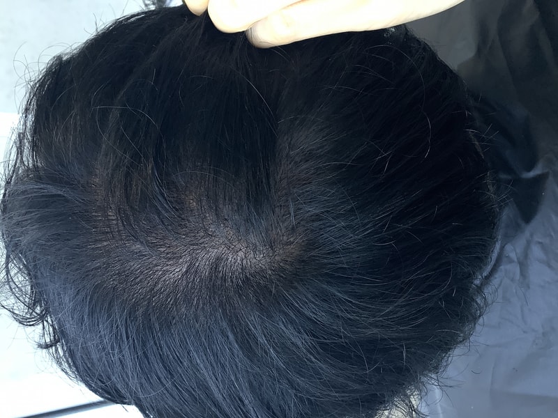 자라다의원) 머리이식후 14일 경과후기.