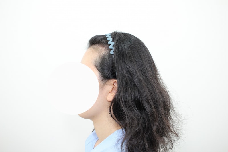 모프로의원 모발이식 10일차 후기