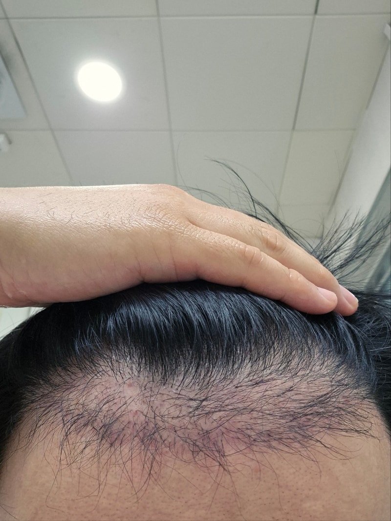 手術4か月目