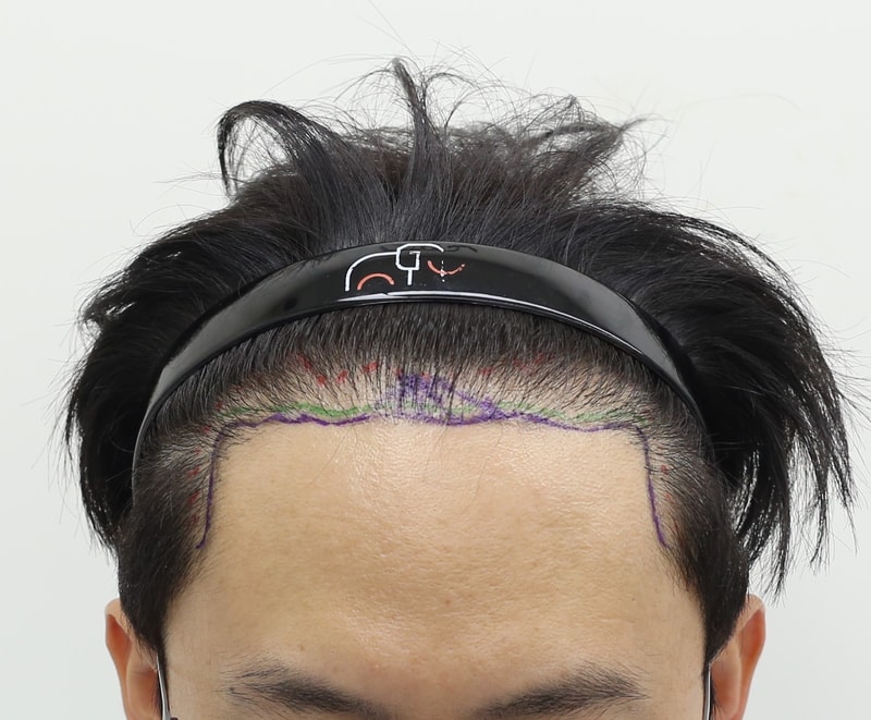 Apgujeong Mammoth Hair Restoration Center's non-intersected Hair Transplant review (re-operation)