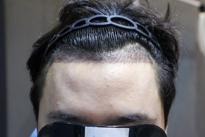 Gwangju Apgujeong Mobiang Clinic Hair Transplant 2 Weeks and the Late Periods