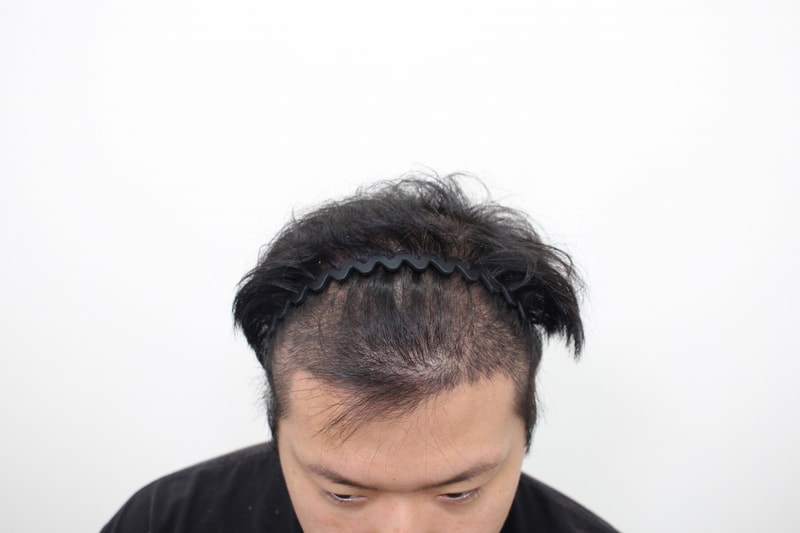 모발이식 14일차 후기