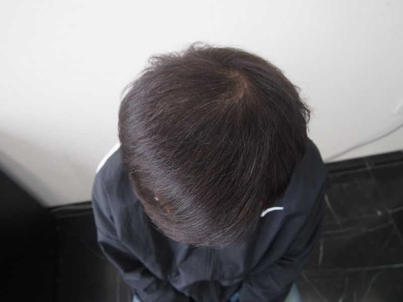 수술후 1년 2.JPG