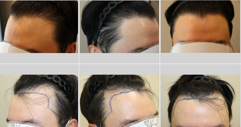 (Former Apgujeong Mobien) Late stage of non-cutaneous 3,200 hair transplant for 9 months