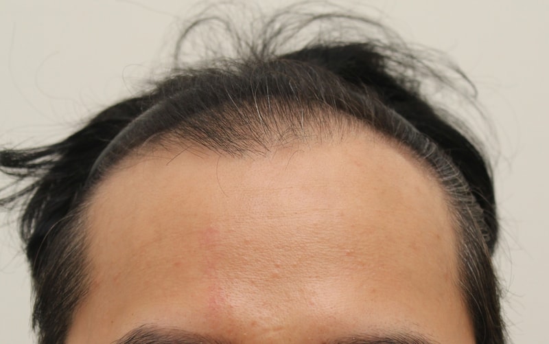 6 months post-transplantation