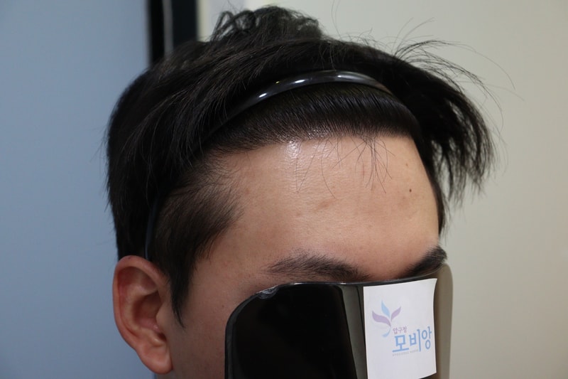 광주 압구정모비앙의원 10개월 경과 후기